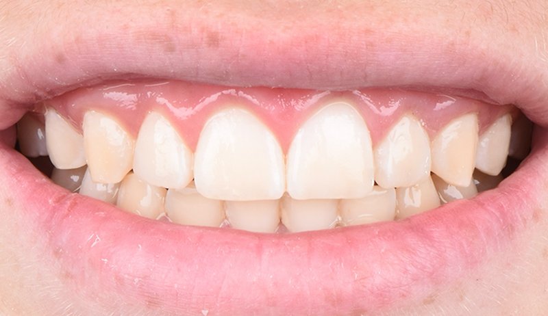denti_dopo1